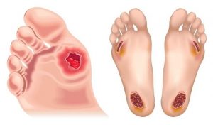 Mengapa Luka pada Pasien Diabetes Sulit Sembuh? Ini Penjelasannya